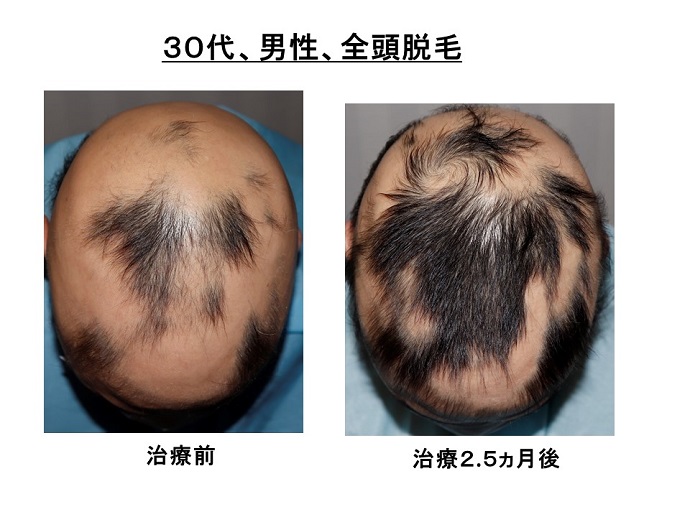 円形脱毛症　病院